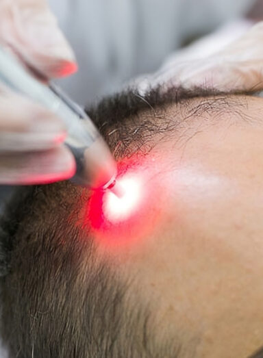 Terapia Capilar a Laser