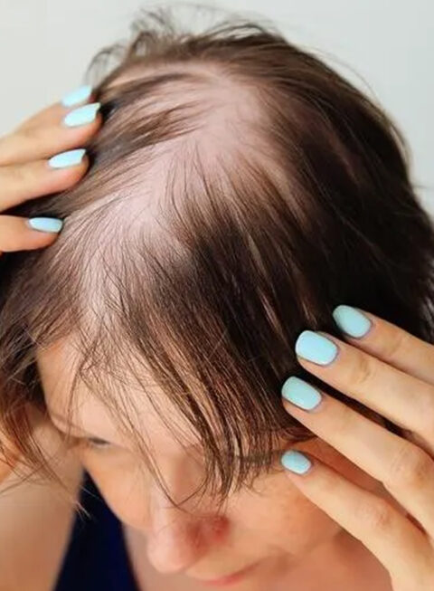 Tratamentos para Calvície Feminina