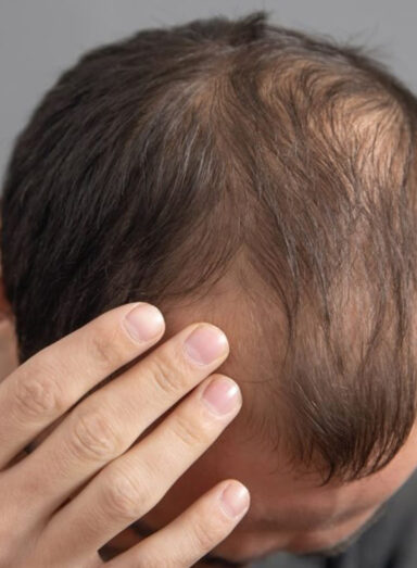 Tratamentos para Calvície Masculina